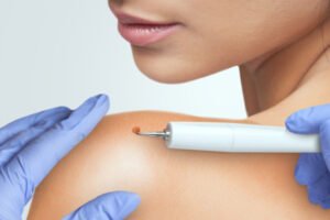 Read more about the article Non Surgical Warts Removal Options 